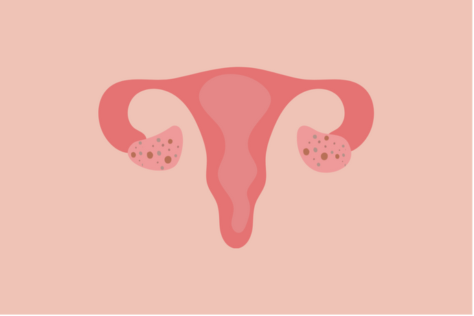 PCOS: What is it, what causes PCOS and symptoms to look out for